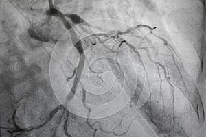 Coronary angiography, Coronary artery disease.