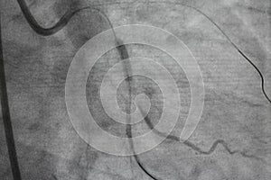 Coronary angiography, Coronary artery disease.