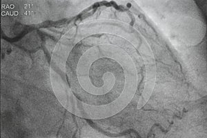 Coronary angiography, Coronary artery disease.
