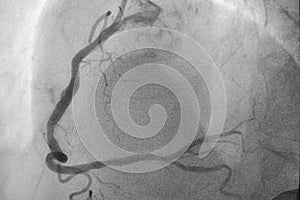 Coronary angiography, Coronary artery disease.