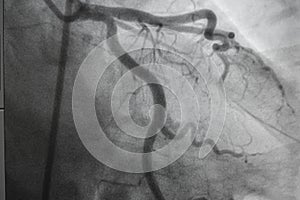 Coronary angiography, Coronary artery disease.