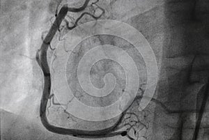 Coronary angiography, Coronary artery disease.