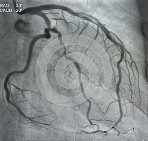 Coronary angiography. x-ray image. photo