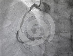 Coronary angiography. Medical x-ray. photo
