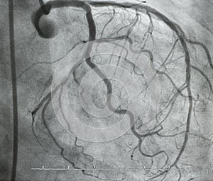 Coronary angiography. x-ray image.