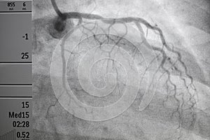 Coronary angiography. x-ray image.