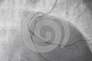 Coronary angiography. x-ray image.