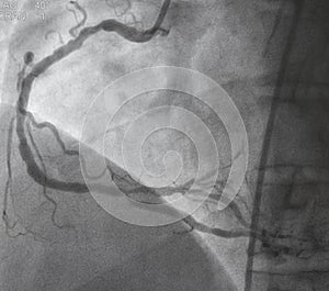 Coronary angiography.right coronary angiography.