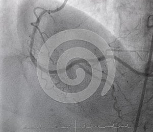 Coronary angiography.right coronary angiography.