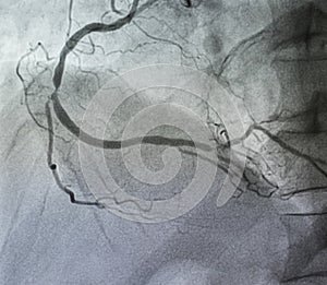 Coronary angiography.
