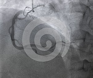 Coronary angiography.right coronary angiography.