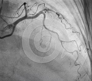 Coronary angiography. x-ray image.