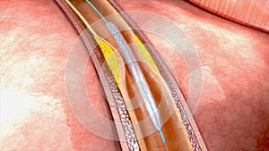 Coronary angioplasty