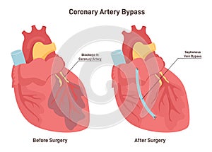 Coronary artery bypass. Damaged heart muscle, blockage of coronary artery.