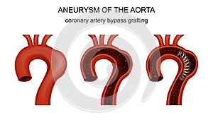 Coronary artery bypass grafting