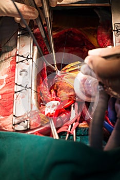 Coronary artery bypass grafting obtuse marginal artery