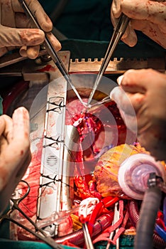 Coronary artery bypass grafting obtuse marginal artery photo