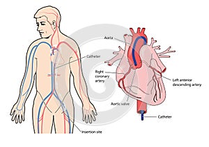 Coronary artery catheter