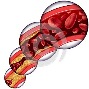 Coronary Artery Cholesterol Therapy