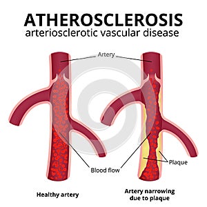 Coronary artery disease