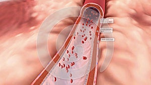 Coronary Artery Disease 3d medical