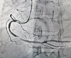 Coronary artery disease