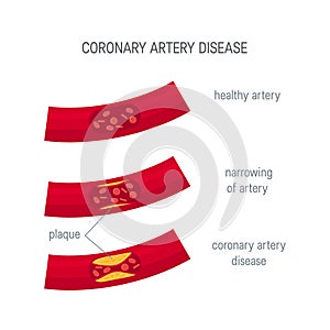 Coronary artery disease concept in flat style