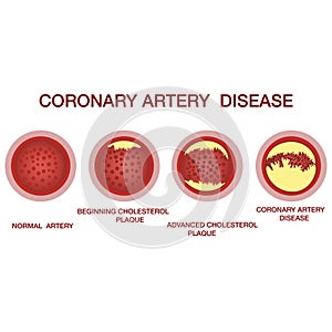 Coronary artery disease concept. Healthy and narrowed arteries with plaques