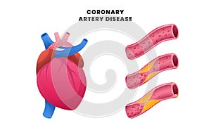 Coronary artery disease with heart cardiac with vein artery with normal and plaque for healthcare cardiovascular