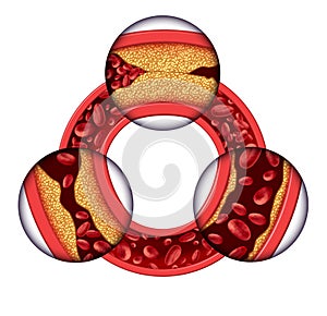 Infarto de miocardio artería enfermedad 