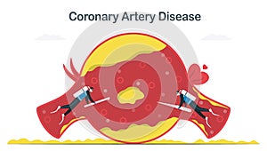 Coronary artery disease treatment that caused by atherosclerosis. More cholesterol and fatty deposits in blood vessel. Cardiology