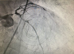 Coronary artery disease Tripple vessle disease with left main severe coronary stenosis bifurcation disease leftmain