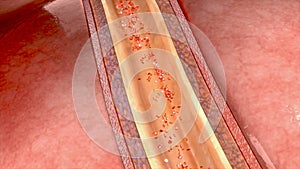 Coronary artery dissection