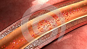 Coronary artery plaque