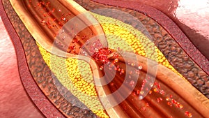 Coronary artery plaque photo