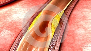 Coronary artery plaque photo