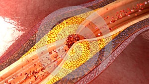 Coronary artery plaque