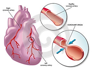 Coronary artery spasm
