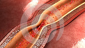 Coronary artery spasm photo