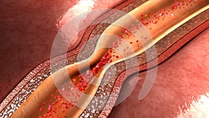 Coronary artery spasm