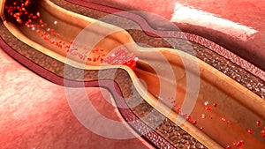 Coronary artery spasm
