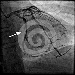 Coronary artery stenosis on angiography photo