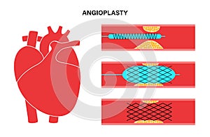 Angioplasty cardiac stent photo