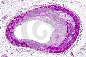 Coronary atherosclerosis, light micrograph