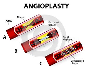 Coronary Balloon Angioplasty. Vector diagram photo