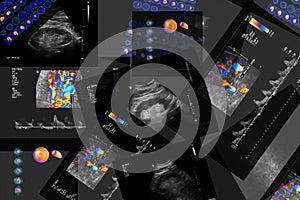 Coronary computed tomography angiography CCTA of the heart and coronary vessels using contrast fluid and stress and determine