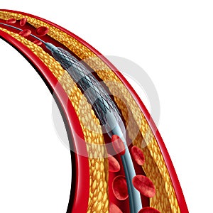 Coronary Stent Placement Isolated