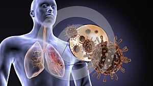Coronavirus attacks human lungs