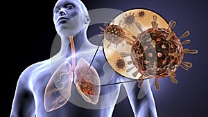 Coronavirus causes pneumonia. Lung infection