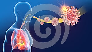 Coronavirus, human coronavirus OC43; lung infection, 3D illustration